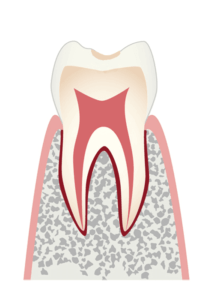 初期の虫歯