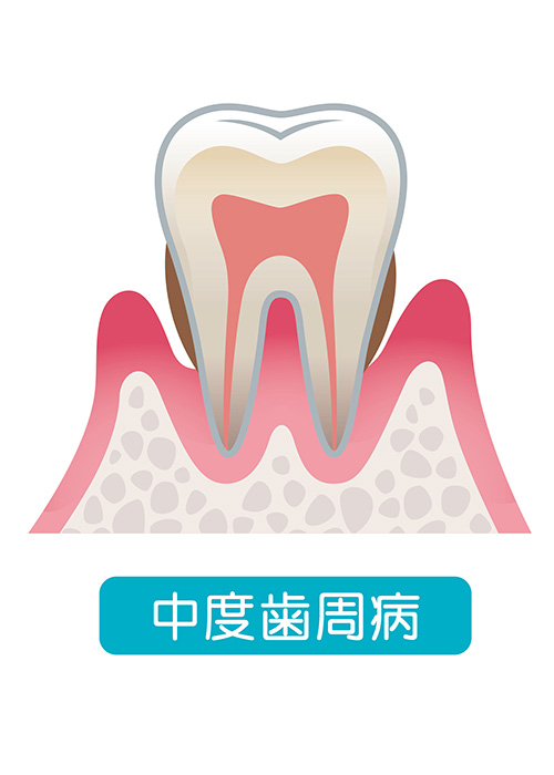 中度歯周病（ここからが歯周炎）