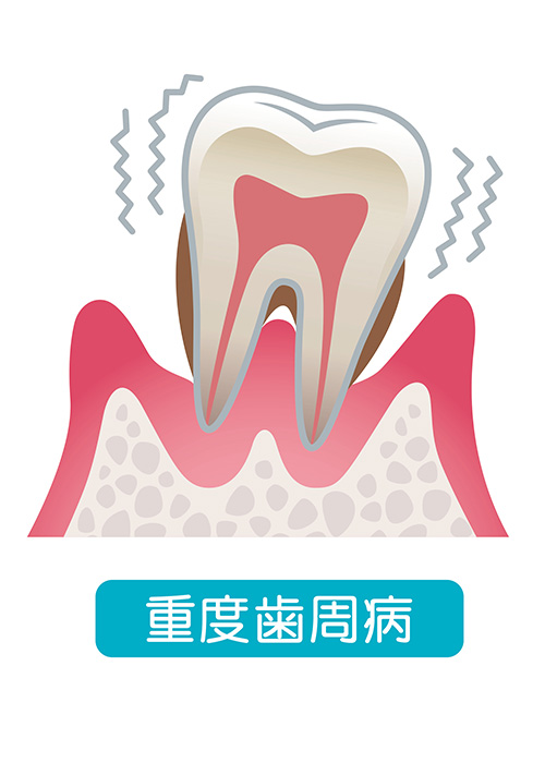 重度歯周病