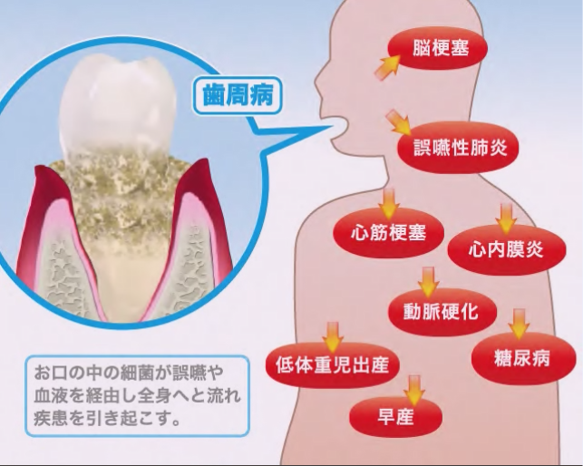 デンタルカルチャーの全身疾患