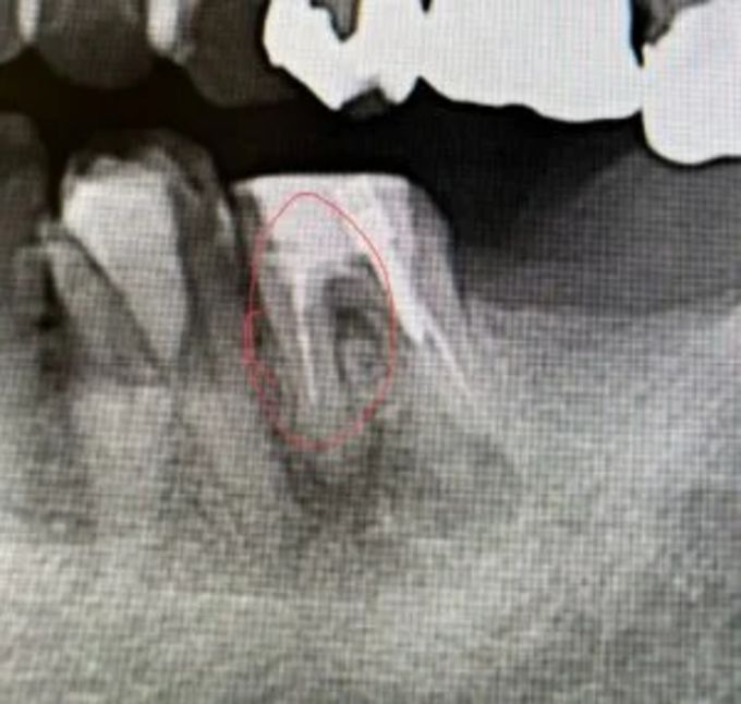 根管内に残ったファイルのレントゲン画像