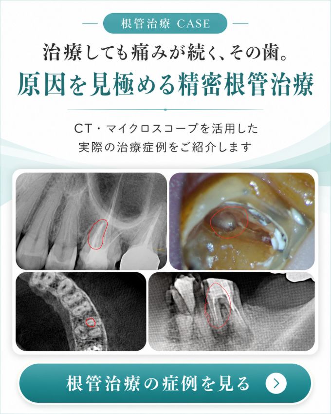 根管治療の症例を見る